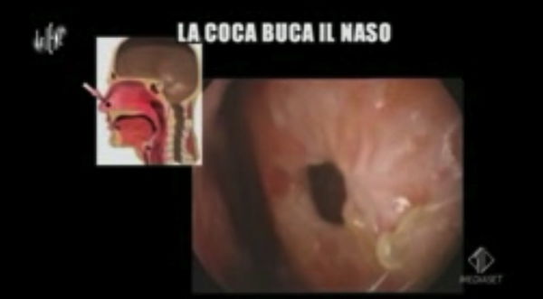 Le Iene, la cocaina e i nasi che si sciolgono
