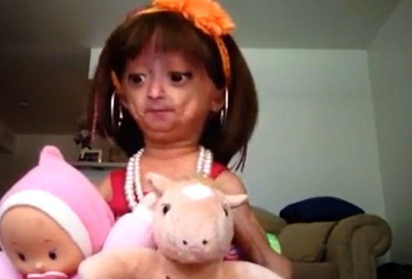 La bambina “vecchia per sempre” vuole aiutare chi ha la sua malattia