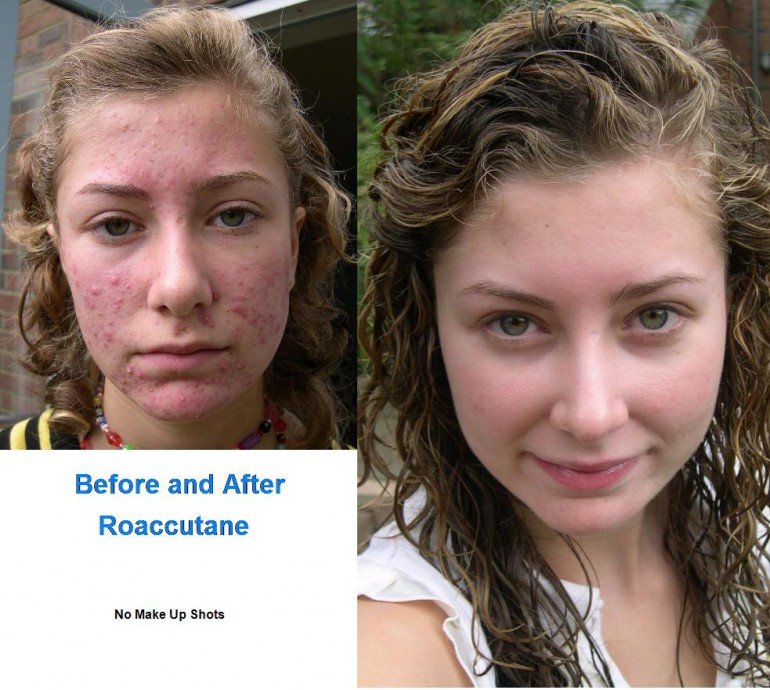 Before and After Roaccutane