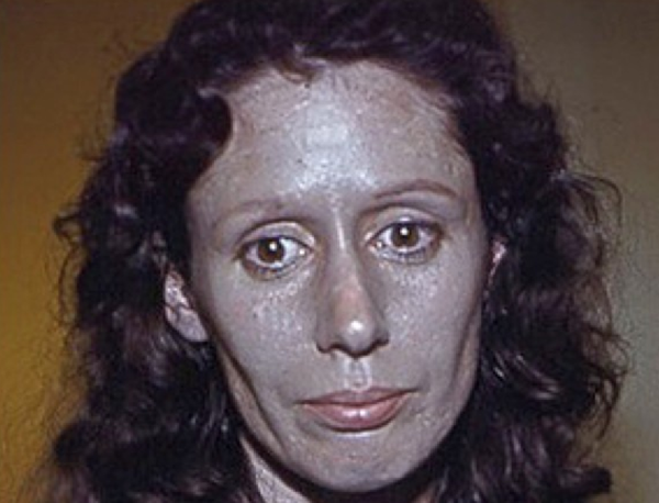 Rosemary Jacobs: la donna con la pelle blu