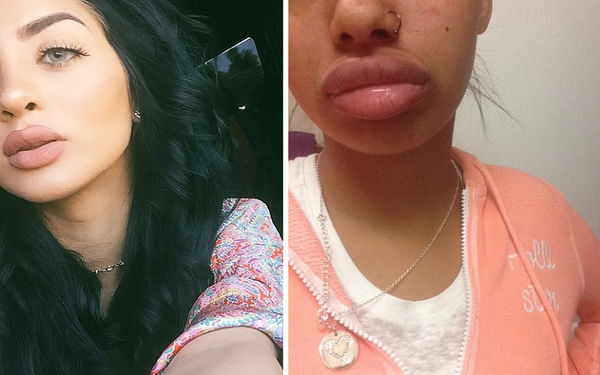 Kylie Jenner Challenge: lo stupido gioco delle ragazzine che rischiano per avere le labbra a canotto
