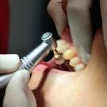 Il trapano del dentista, uno dei rumori più fastidiosi