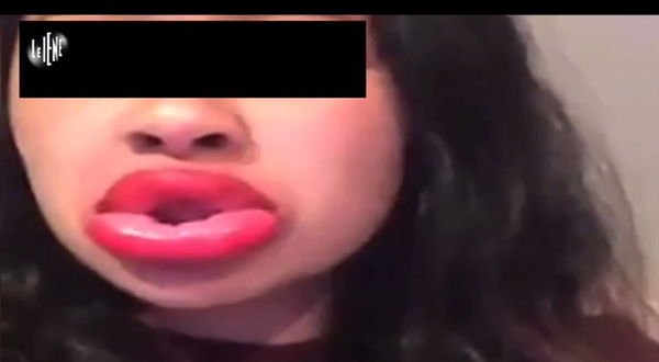 Le Iene e pericoli dei “labbroni sottovuoto” fai da te del Kylie Jenner Challenge