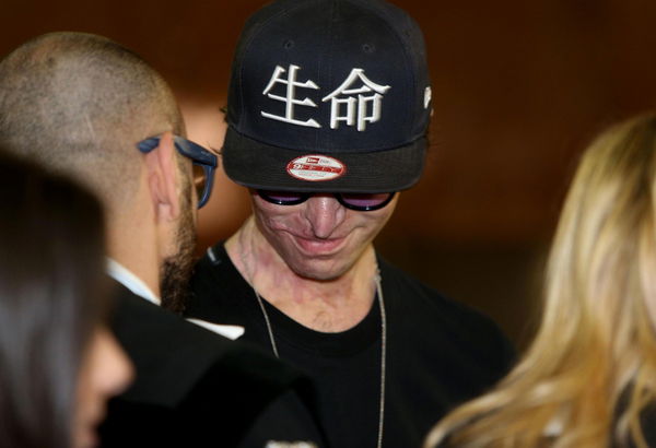 Stefano Savi, sfigurato per errore della “coppia dell’acido”