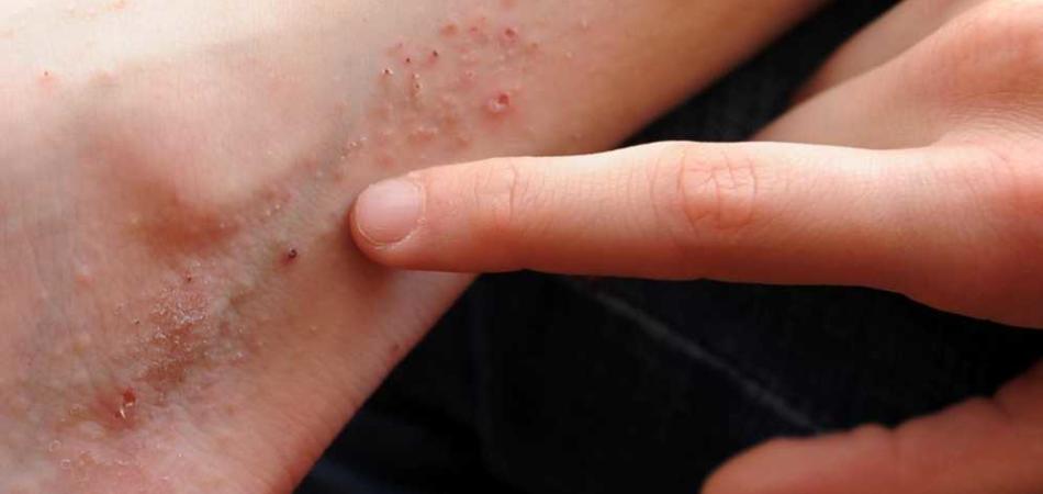 dermatite atopica