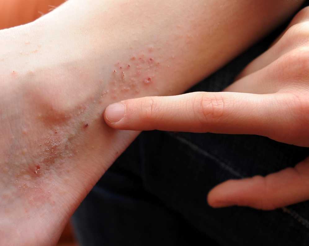 Quando la dermatite atopica ti fa impazzire article-post