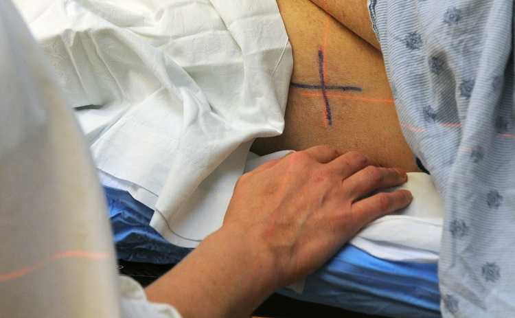 radioterapia steriotassica sulla prostata