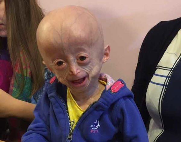 È morta Lucy Parke, la bambina di 8 anni con il corpo di un’anziana