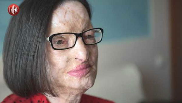 Il coraggio di Filomena, sfigurata dall’acido