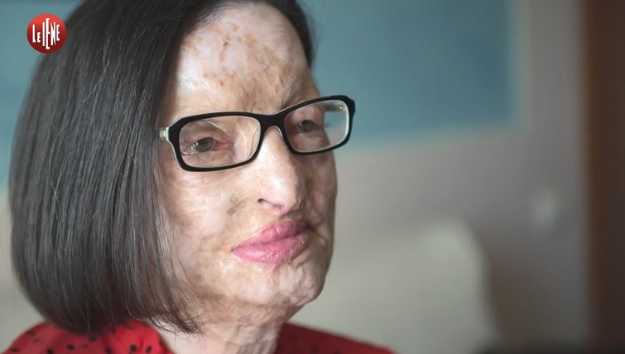 Il coraggio di Filomena, sfigurata dall’acido article-post