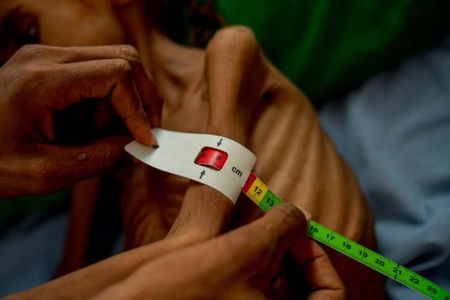 Amal, la bambina dello Yemen che ha scosso l’America, è morta article-post