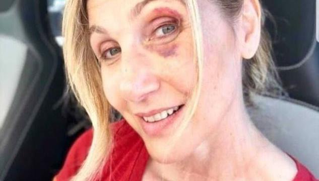 lorella cuccarini caduta per colpa di una buca
