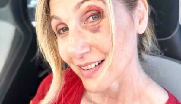 Lorella Cuccarini vittima delle buche di Roma: la foto con i lividi dopo la caduta