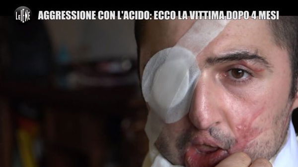 Sfregiò con l’acido l’ex fidanzato: condannata a sette anni e 10 mesi di carcere