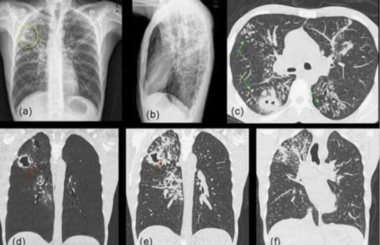 La bufala della mascherine che provocano la candida polmonare