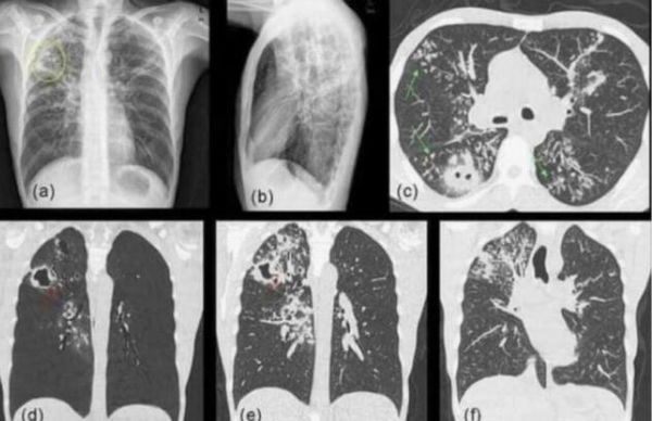 La bufala della mascherine che provocano la candida polmonare