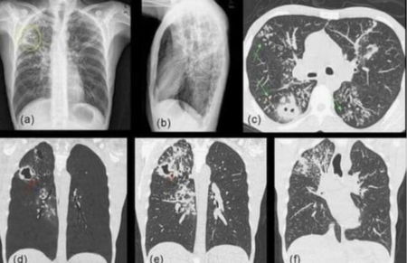 La bufala della mascherine che provocano la candida polmonare article-post
