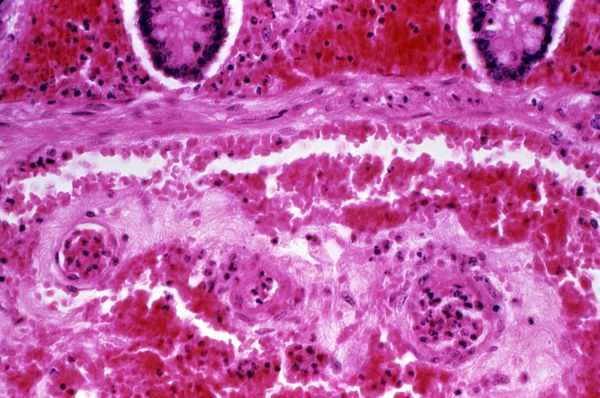 Malattia di Crohn: cos’è e quali complicanze può portare 