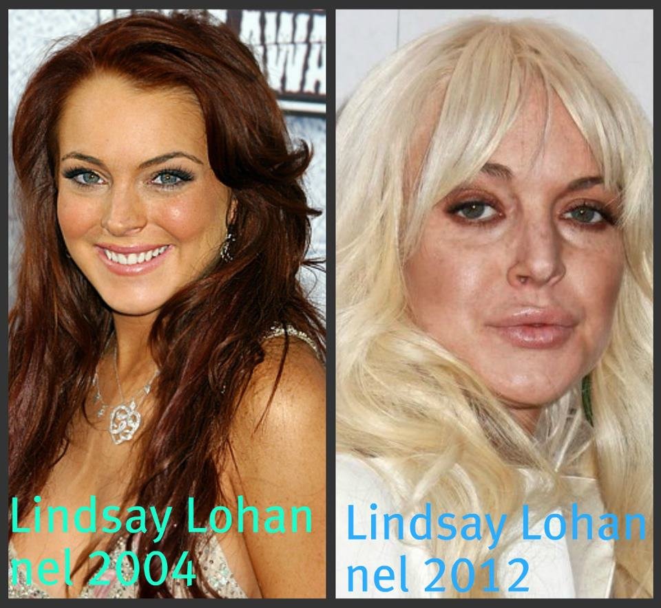 Lindsay Lohan rovinata dalla chirurgia estetica: foto