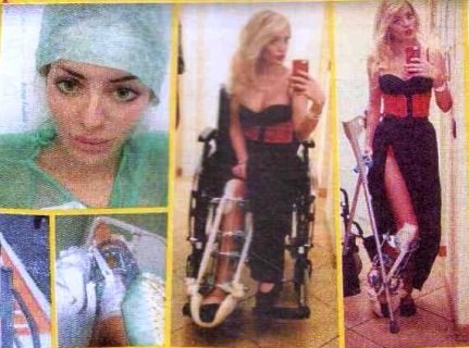 Elena Morali caduta sugli sci: fratture gravi e lunga riabilitazione