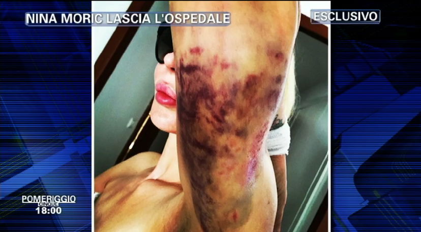 Nina Moric su Instagram: “Non ho tentato il suicidio, ho solo avuto un incidente domestico!” preview