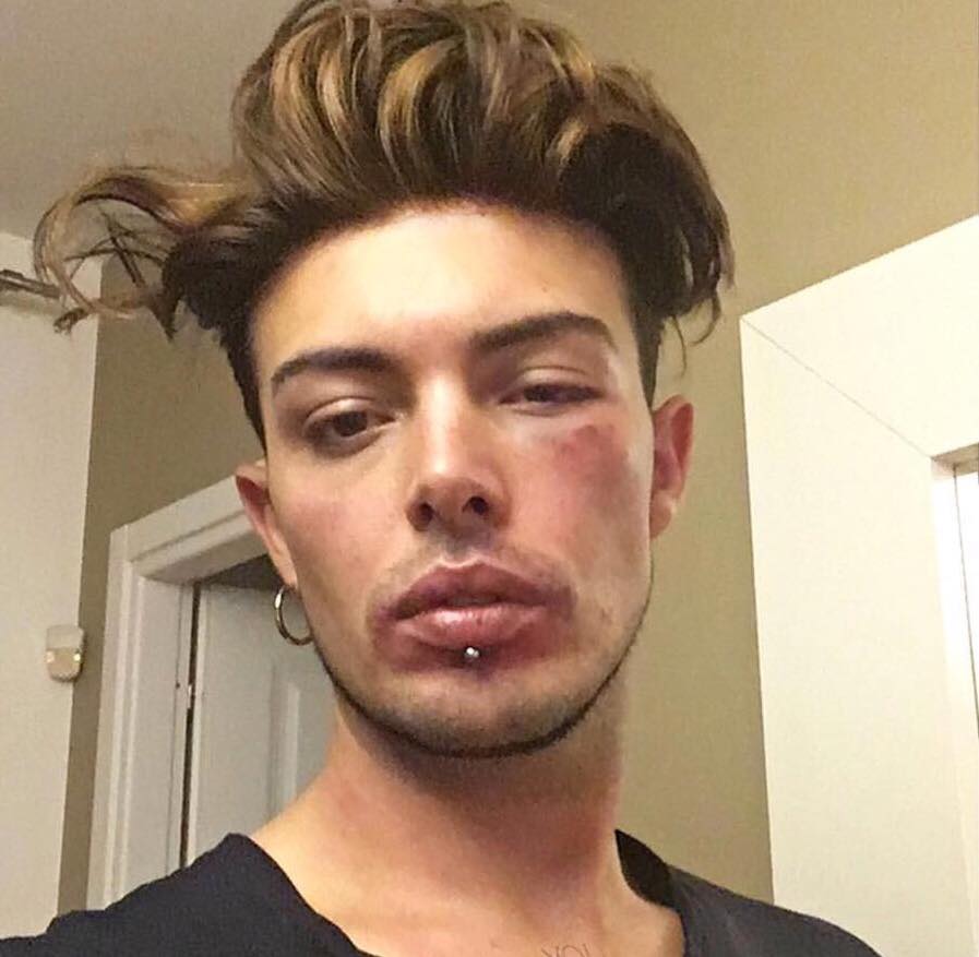 ‘Amici 14′, Stash Fiordispino pubblica una foto del suo viso pieno di lividi: ecco cosa è successo article-post