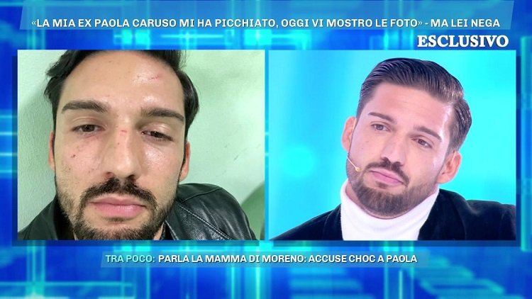 ‘Domenica Live’, Moreno Merlo replica alle accuse di Paola Caruso mostrando le foto del proprio volto ferito. E la madre dell’ex tentatore rincara la dose! (Video)
