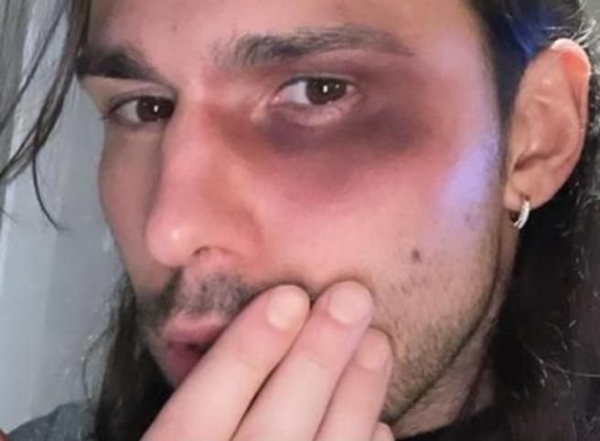 Gf Vip, Luca Onestini con un occhio nero per difendere la fidanzata: ecco cosa è successo