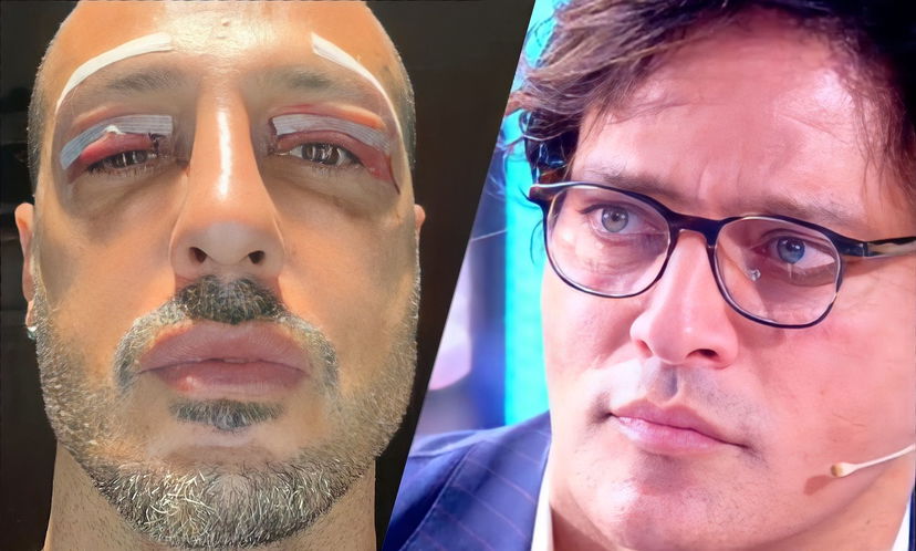 Fabrizio Corona si mostra sui social dopo un’operazione estetica, poi lancia una frecciatina a Gabriel Garko preview