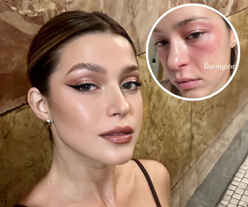 Natalia Paragoni mostra il viso rosso e fortemente infiammato dopo la Milano Fashion Week: le immagini preview