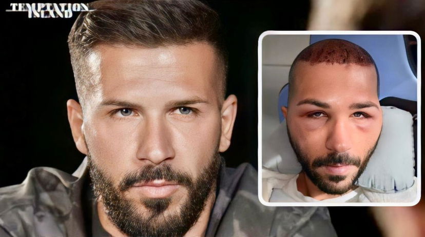 Temptation Island, Federico Rasa rompe il silenzio dopo il caos al Pronto Soccorso: “Dopo 3 ore che stavo là con la faccia tanta…” preview