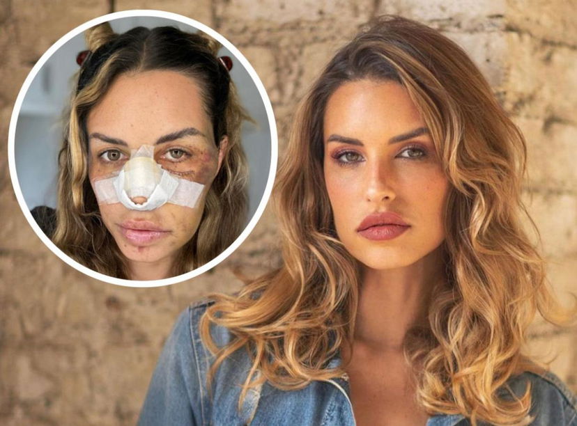 Temptation Island, Carlotta Adacher racconta i dettagli dell’incidente stradale che le ha lesionato il volto (Video) preview