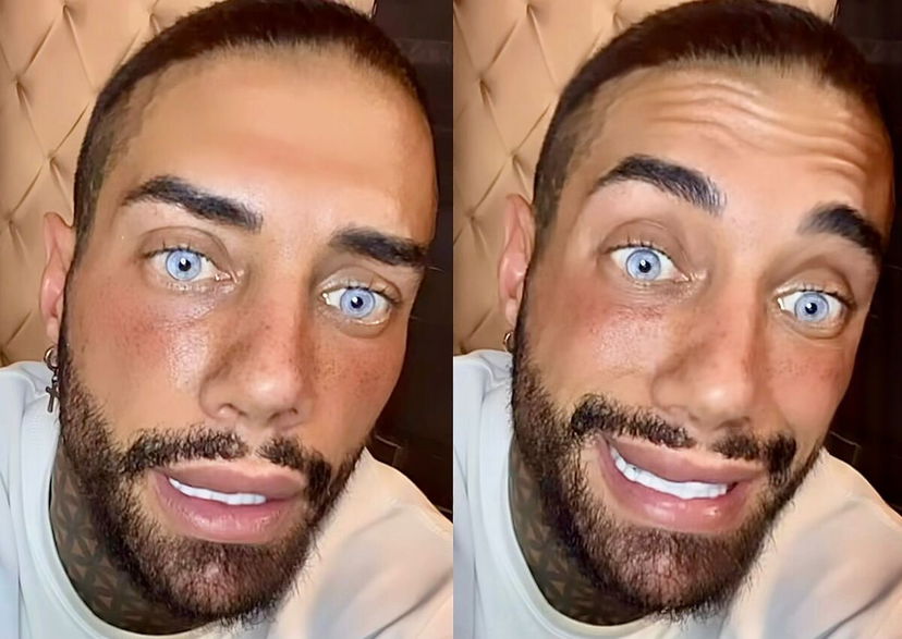 Francesco Chiofalo conferma: “Mi affascina l’intervento di allungamento delle gambe perché…” preview