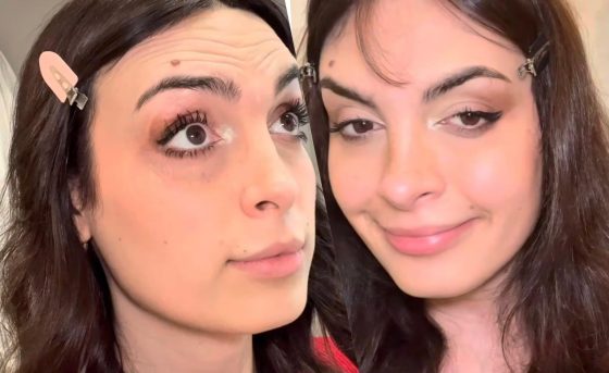 Uomini e Donne - Andrea Nicole Conte botox