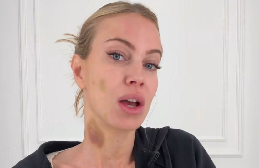 Taylor Mega allarma i fan mostrando degli evidenti lividi sul collo e sul viso: lei risponde e spiega il motivo preview