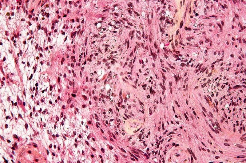 I cellulari, il cancro e il legame con il neurinoma article-post
