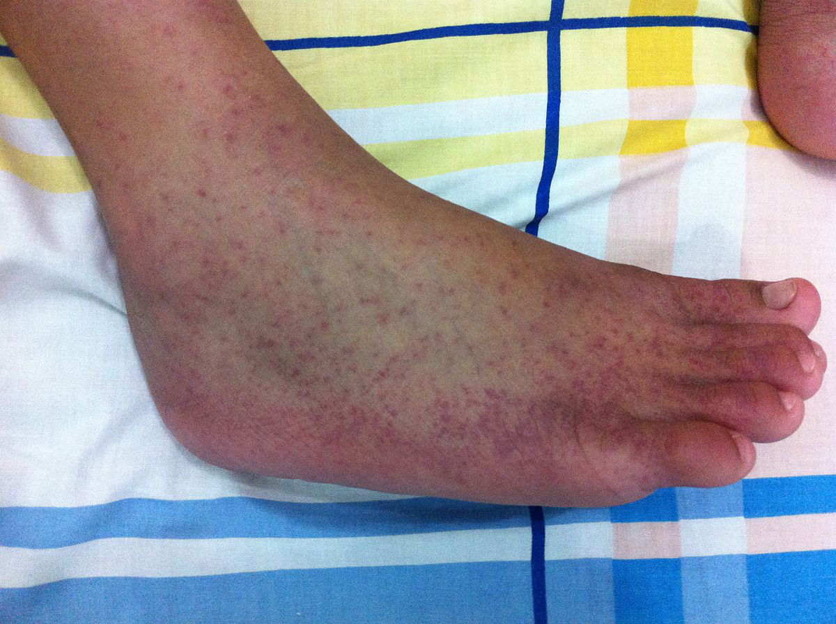 Chikungunya: i casi ad Anzio della malattia che si trasmette con le zanzare article-post