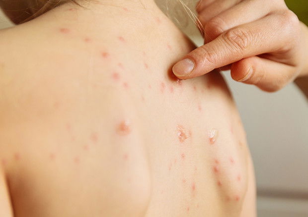 Il quarto morto per il morbillo in Italia article-post