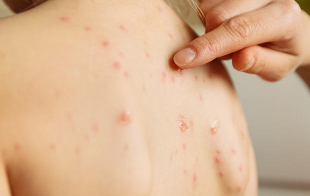 morbillo messico italiani - 4