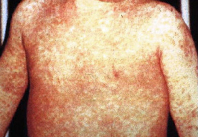 Il bimbo di dieci mesi morto per il morbillo a Catania article-post