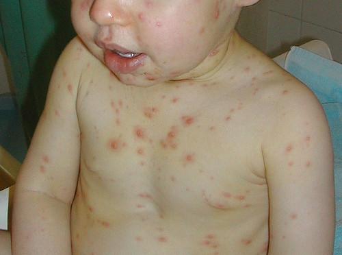 I due bambini ricoverati per varicella a Pavia article-post