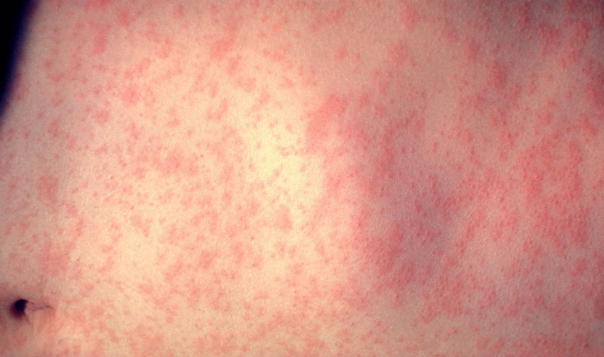 Il morbillo in ospedale portato dal bimbo non vaccinato article-post
