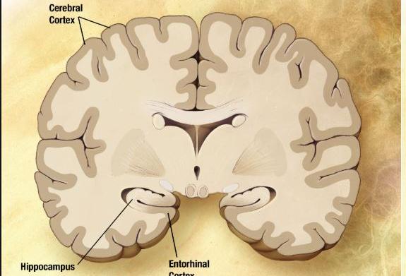 alzheimer 1