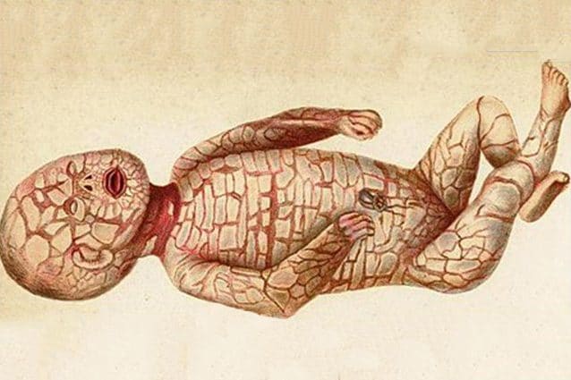 Ittiosi Arlecchino: cos’è la malattia genetica di cui è affetto Giovannino article-post