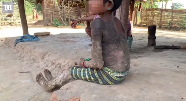 Cos’è l’ittiosi epidermolitica, la malattia che affligge una bambina indiana di sette anni article-post