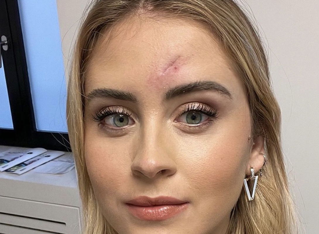 Cosa è il carcinoma basocellulare che ha colpito Valentina Ferragni article-post