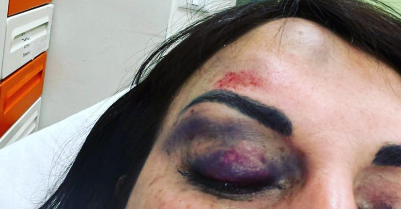 Il coraggio di Francesca De André che mostra i segni della violenza dell’ex compagno article-post