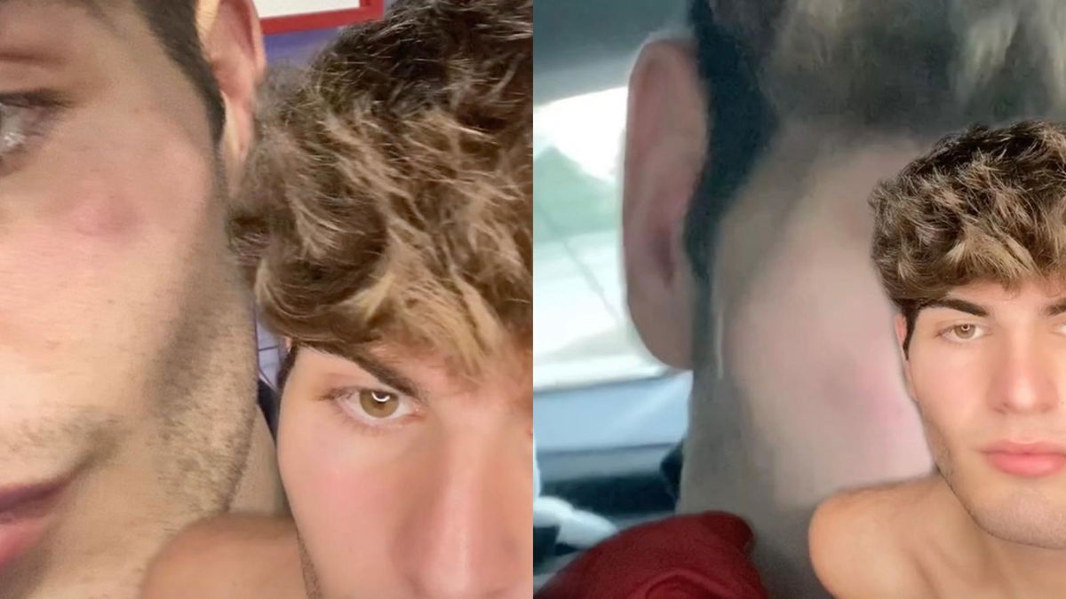 “Sei la feccia d’Italia”, poi le botte: l’aggressione omofoba subita da Lorenzo Sabato a Gallipoli | VIDEO article-post