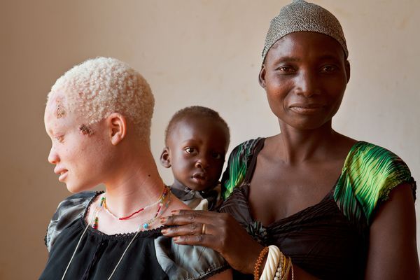 Tanzania: tra incantesimi e superstizioni è caccia agli albini article-post