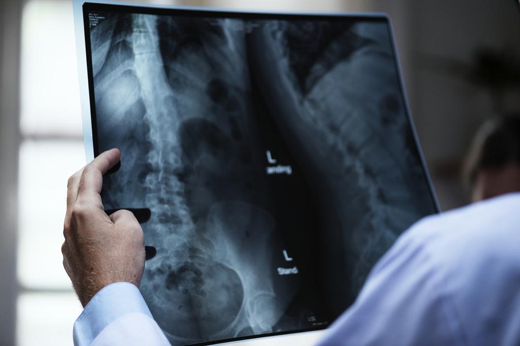 Assumere alte dosi di Statine aumenta il rischio di osteoporosi article-post